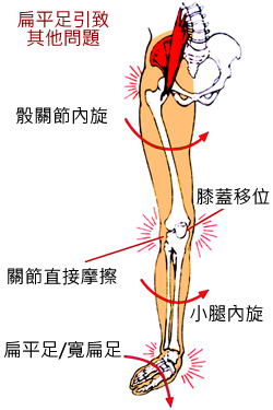 flatfoot complication